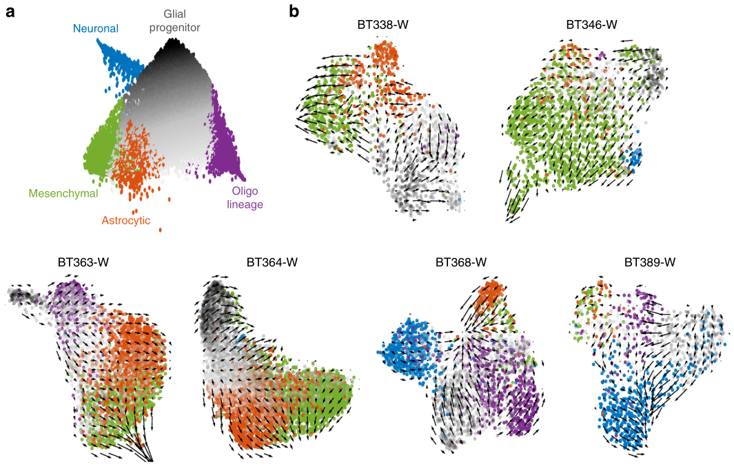 圖2?基于RNA?velocity分析膠質(zhì)母細(xì)胞瘤細(xì)胞分化路徑[4]
