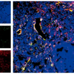 《cell reports》慢性肉芽腫病的發(fā)病機制新發(fā)現(xiàn)